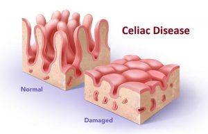 Intestinal biopsy is not always required to diagnose celiac disease: a retrospective analysis of combined antibody tests
